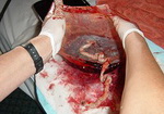 placenta